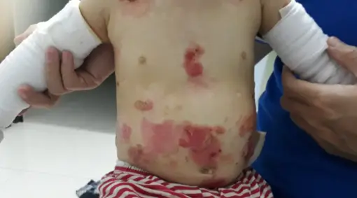 Baby John was born had rare EB Blistering Skin Disease. 